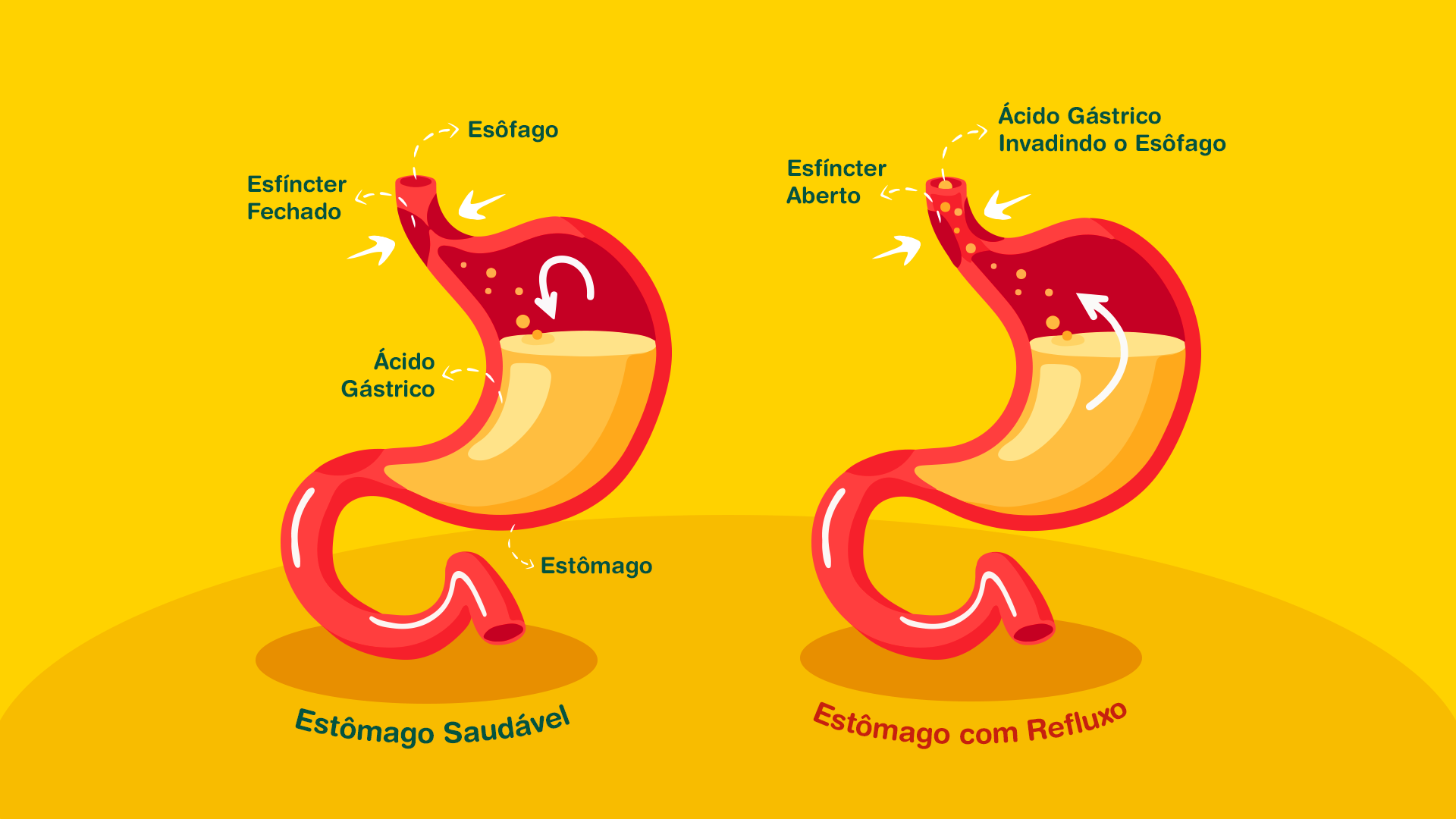 Queimação e refluxo origem causa e tratamentos Rotina da Saude