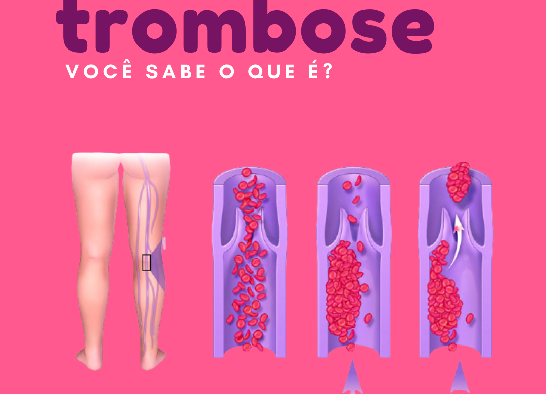 Ilustração de pernas com veias afetadas pela trombose e texto sobre fundo rosa "Trombose: você sabe o que é?"